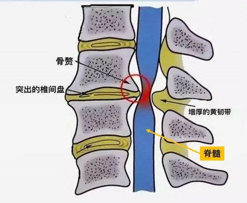 椎間盤退變